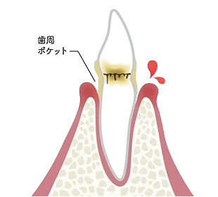 P2 歯周炎 軽度