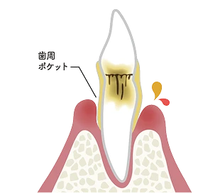 P3 歯周炎 中等度