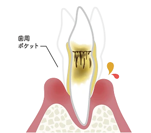 P4 歯周炎 重度