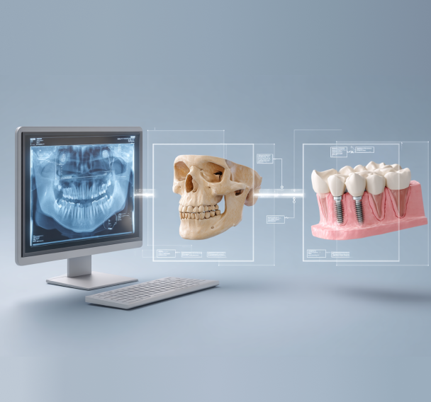 サージカルガイドを使用したインプラント手術