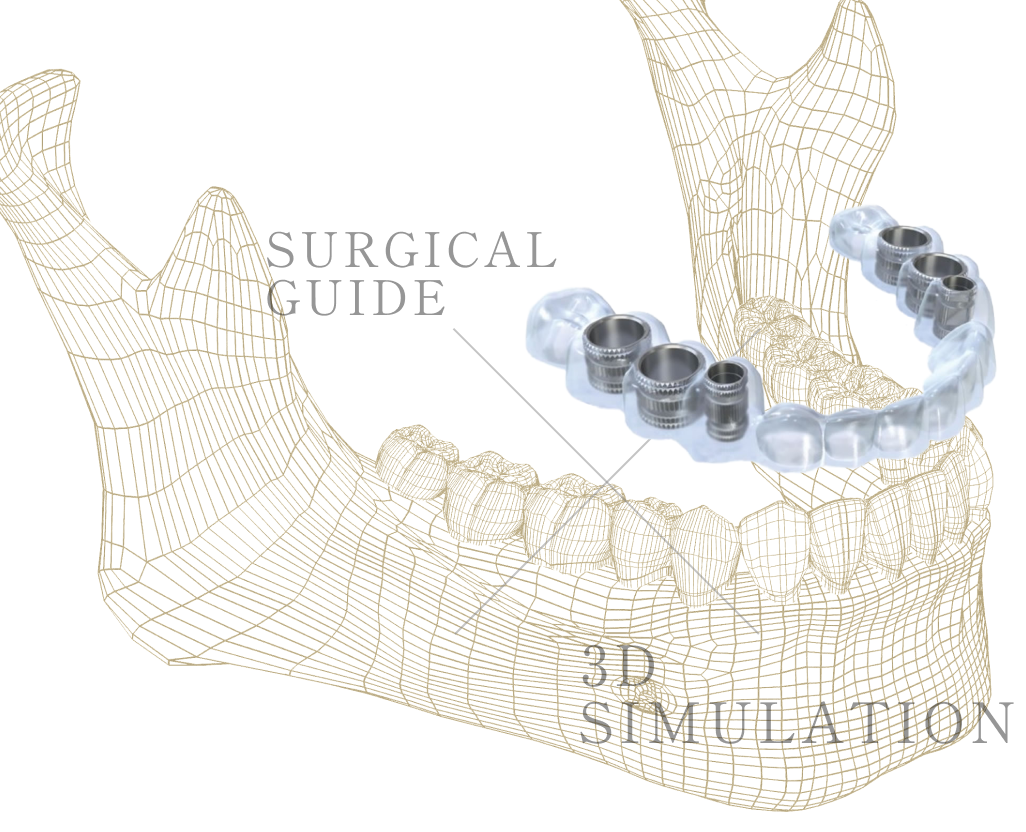 インプラント治療のイメージ